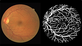 眼底視網(wǎng)膜血管圖像分割